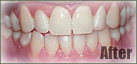 invisalign-case1-after